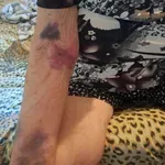Жена влезе с пневмония в пернишката болница, излезе обезобразена