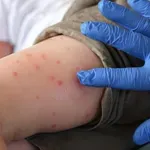 Пет нови случая на морбили в Ловешко