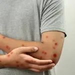 ТРЕВОЖНО: Броят на болните от морбили продължава да расте!