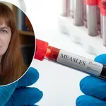 Д-р Кремена Пармакова пред "Телеграф": Морбили може да доведе до слепота