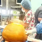 Лекари извадиха 27-килограмов тумор от корем на жена