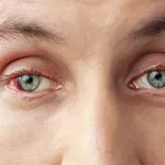 Se zbujate z rdečimi očmi? Vzroki in kdaj k zdravniku