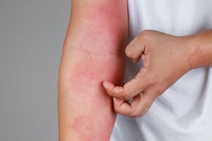 Atopijski dermatitis – kaj je in kako ga obvladovati?