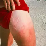 Kako ravnati, če te ožge meduza