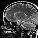 Nova studija otkrila visoku razinu Alzheimerova proteina kod novorođenčadi
