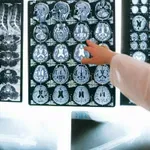 MR mozga: Kako točno izgleda i kada se radi ova važna pretraga glave?
