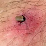 Sezona krpelja – što sve treba znati i kako se zaštititi?
