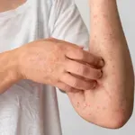 Majmunske boginje (mpox) ponovno se šire: Virus se pojavio u novim zemljama, može li se epidemija zaustaviti?