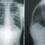 Bolest pluća koju mnogi zamjenjuju s astmom: Ovih šest simptoma ne smijete ignorirati