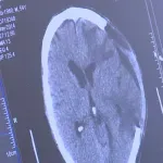 Znanstvenici presadili laboratorijski uzgojeno ljudsko moždano tkivo u miševe