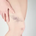 Često vam se pojavljuju modrice na tijelu? Ovo su mogući razlozi njihova nastanka
