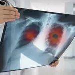 Istina koja stoji iza sedam uobičajenih mitova o raku pluća