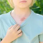 Hemangiomi kod dece - kada je potrebno obratiti se lekaru