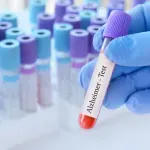 Novi test iz krvi mogao bi da predvidi rizik od Alchajmerove bolesti