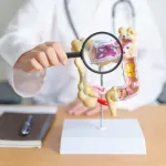 Broj obolelih od karcinoma debelog creva raste - doktor ukazao na faktore rizika
