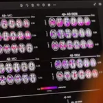 Alzheimer και «χάπια αδυνατίσματος»: Οι ελπίδες που δεν επιβεβαιώθηκαν