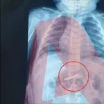 Αθήνα: Μόλις 3 ετών αγοράκι κατάπιε ξυραφάκι – Σώθηκε την τελευταία στιγμή (Βίντεο)