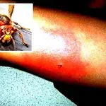 Po bodnutí sršně jde o čas: Prvních 5 minut může zachránit život