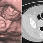 Nebezpečí kolonoskopie: Jestliže Vám lékař navrhne toto vyšetření, odpovězte mu toto!