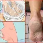 Neutrácejte peníze za pedikúru: použijte tyto dvě ingredience z vaší kuchyně a vaše nohy budou vypadat úžasně!