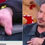 Άρης Μουγκοπέτρος - Έδειξε το τεχνητό μέλος: «Θα επιστρέψω στη δουλειά μου»