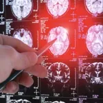 Nije svaka glavobolja rak mozga: Ljekar upozorava kada je vrijeme da potražite pomoć