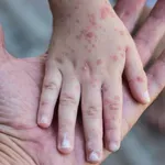 Nevakcinisano svako drugo dijete u vrtićima