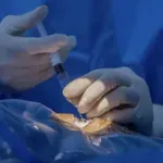 Revolucionarna injekcija gela u oko: Nada za hiljade ljudi