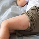 Britanija gubi status zemlje bez malih boginja