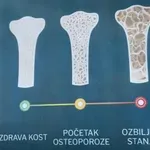 Proverite zdravlje svojih kostiju: Dom zdravlja Niš omogućava denzitometriju bez zakazivanja