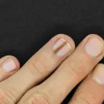 Tamna linija na noktu može ukazivati na melanom