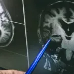 Nova terapija može odložiti Alchajmerovu bolest i to za sedam godina