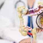 Sve veći porast raka debelog crijeva kod mladih: Niko nije premlad za ovu dijagnozu