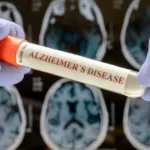 Novi ljekovi za Alchajmer pod lupom: Efekat znatno manji od očekivanog