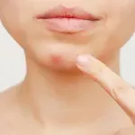 Akne na licu nisu slučajne: Mjesto gdje se pojavljuju otkriva šta vam zapravo šteti koži