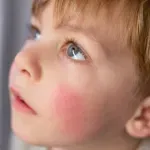 Dermatolog savjetuje kako se boriti sa atopijskim dermatitisom