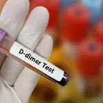 D-dimer test: Šta znači povišen nalaz i kada je vrijeme za brigu?