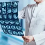 Nova nada za liječenje glioblastoma: Otkriven "prekidač" koji pokreće najopasniji tumor mozga