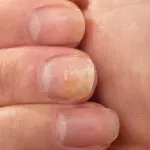 Kako prepoznati simptome psorijaze noktiju i na koji način ublažiti tegobe