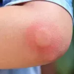 Šta učiniti ako vaše dijete ubode pčela ili osa