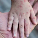 Drakonske kazne za roditelje, vrtiće i ljekare zbog MMR