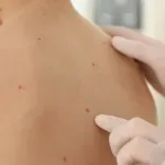 Ovčje boginje kod djece - kakvi su simptomi i na koji način se liječe
