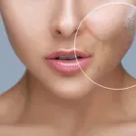 Akne se mogu javiti i kod odraslih, dermatolozi objašnjavaju kako ih liječiti