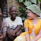 Jeziva sudbina albino crnaca: Bogataši veruju da im njihovi delovi tela mogu doneti novac i moć