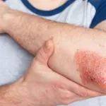 Udruženje pacijenata: Obolelima od psorijaze dostupne sve efikasne terapije u Srbiji