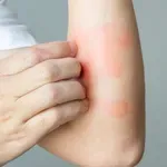 Psorijaza: Uzroci, simptomi i lečenje