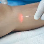 Dr Dario Jocić o laserskoj operaciji vena: Kako moderna metoda menja kvalitet života