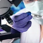 Povišeni leukociti nisu uvek znak infekcije: Evo na koja sve stanja mogu da ukazuju