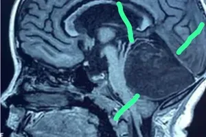 Zdravniki menili, da gre za tumor na možganih, kasnejše odkritje pa jih je pustilo odprtih ust