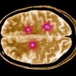 Neozdravljiva bolezen, ki prizadene možgane: to so simptomi, ki se lahko pojavijo že leta pred diagnozo